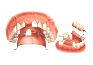 protez diş tedavisi sefaköy, sefaköy protez diş tedavisi, küçükçekmece protez diş tedavisi, protez diş tedavisi küçükçekmece