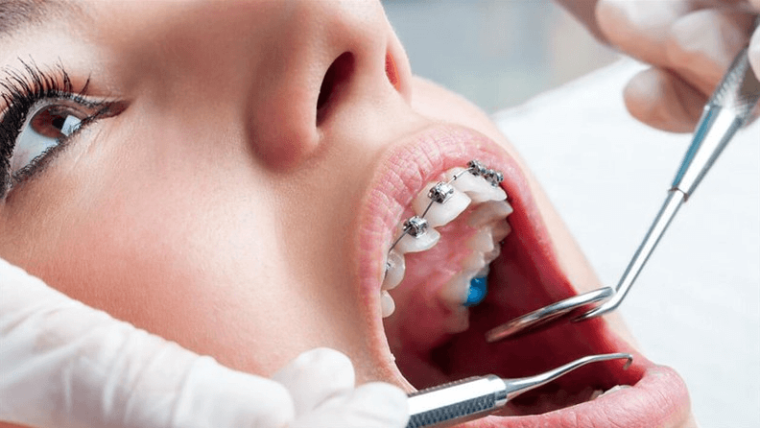 Ortodontik Tedavi Sırasında Beslenme Nasıl Olmalıdır?