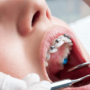 Ortodontik Tedavi Sırasında Beslenme Nasıl Olmalıdır?