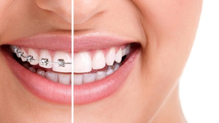Sabit ve Hareketli Ortodontik Apareyler Kimler İçin Kullanılır?